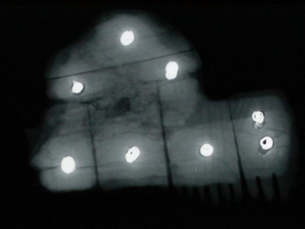 Rentgenový snímek kostěného hřebenu s kovovými nýty.